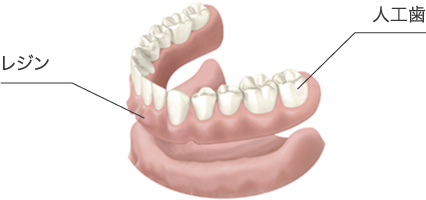レジン 人口歯